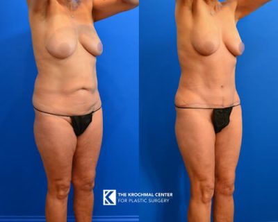 2 Abdominoplasty- snatched waist near Chicago