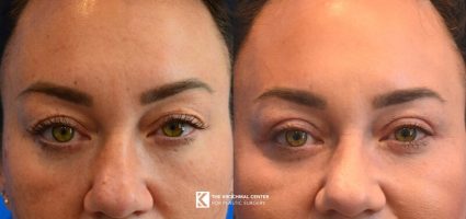 2 Blepharoplasty Western Springs Illinois