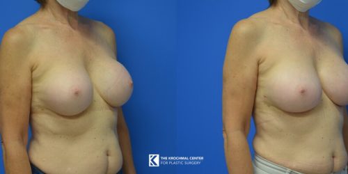 En Bloc Breast Implant Exchange