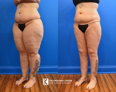 2 Lipedema Liposuction for large legs in Chicago