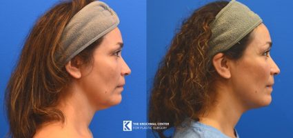 Combine neck liposuction with MyEllevate to create a contoured neck and jawline in St Charles Illinois