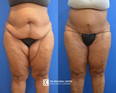 Thinner thighs with a thigh lift after weight loss photos