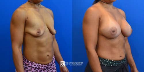 22 Breast Augmenation for bigger boobs in Chicago