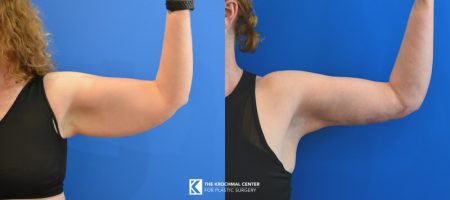 Arm lift brachioplasty result from plastic surgery near me in Chicago