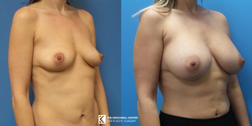 Breast augmentation Chicago Cosmetic