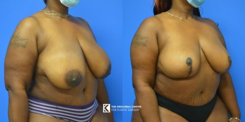 3 Breast Reduction- Chicago for heavy breasts