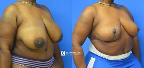 Breast Reduction in Plus-Size Woman