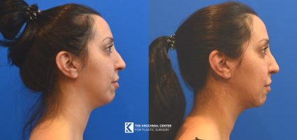 Do neck liposuction with MyEllevate to contour your neck near me in Chicago Illinois