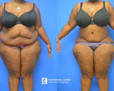 Plus size abdominoplasty