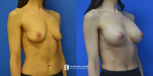 4 Breast Augmentation in Elmhurst Illinois