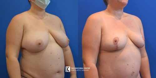 Breast reduction pics for large breasts and back pain relief