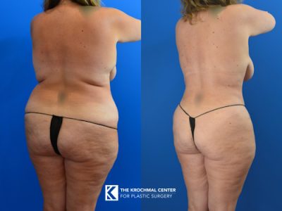 4 Liposuction- back shaping near Naperville