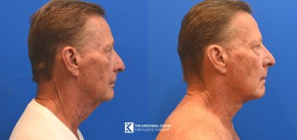 Neck lift procedure near Western Springs Illinois