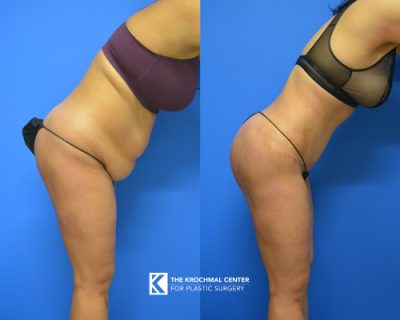 5 Abdominoplasty- near Burr Ridge Illinois