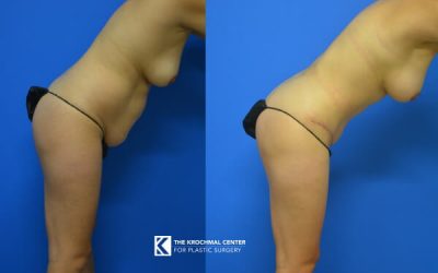 Chicago and Hinsdale Abdominoplasty and Tummy Tuck Photos