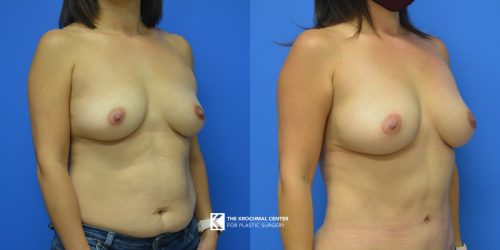 6 Breast Augmentation fat grafting to breast Oak Brook Illinois