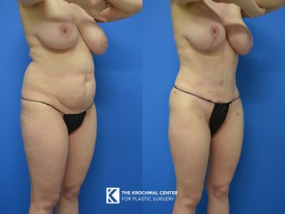 7 Abdominoplasty- Glen Ellyn Illinois