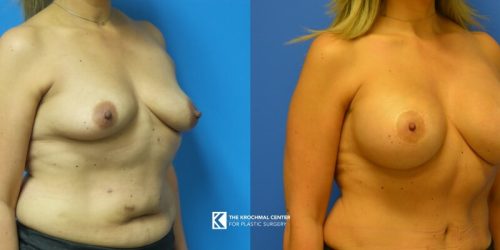 Breast augmentation with lift near Chicago