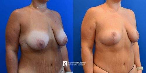 Chicago breast lift results