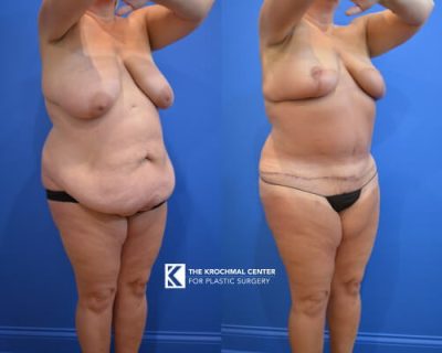 Tummy tuck and breast lift near Downers Grove