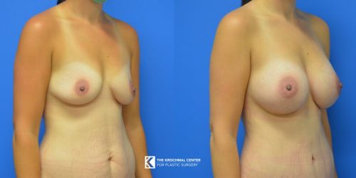 Breast augmentation photos near me