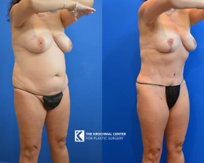 Abdominoplasty with breast lift near Hinsdale with a great result